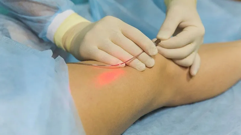Chữa Trị Suy Giãn Tĩnh Mạch Bằng Phương Pháp Laser